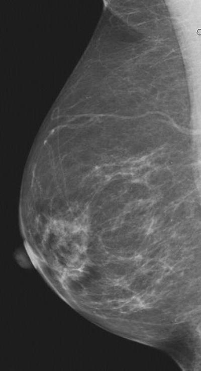 Fatty Breast Tissue