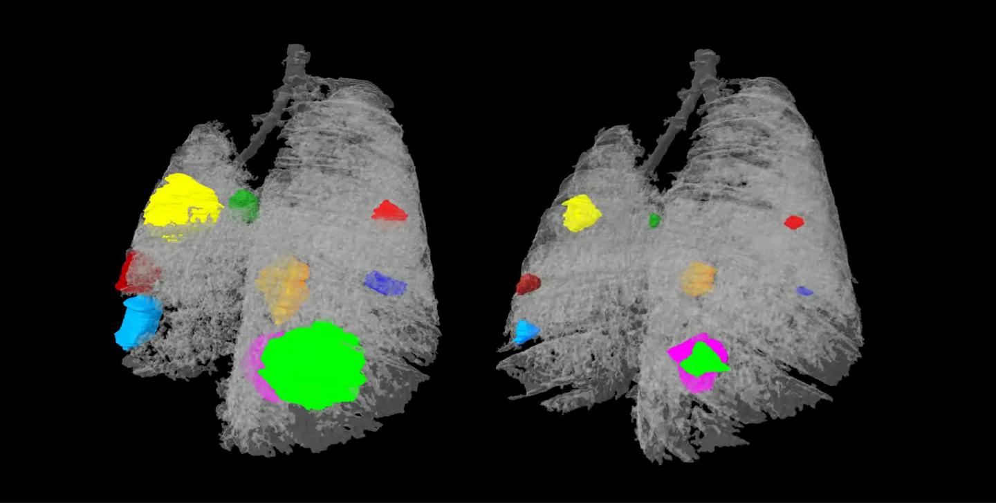 Lung Tumors after Three-Drug Combination Treatment