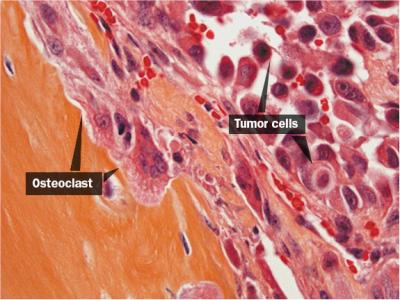 Tumor Cells Invade Bone