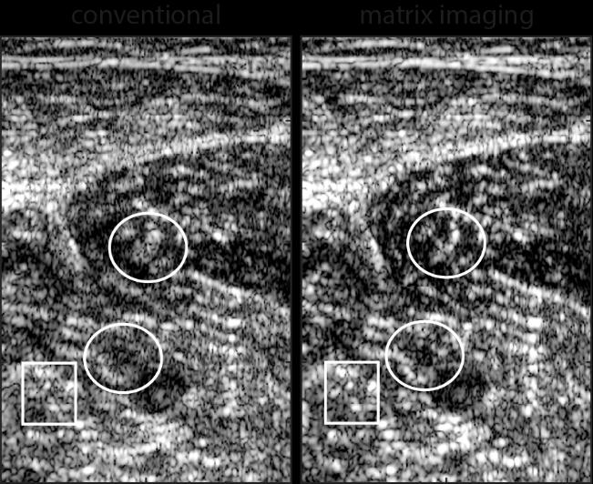 Matrix Imaging: An Innovation for Improving Ultrasound Resolution