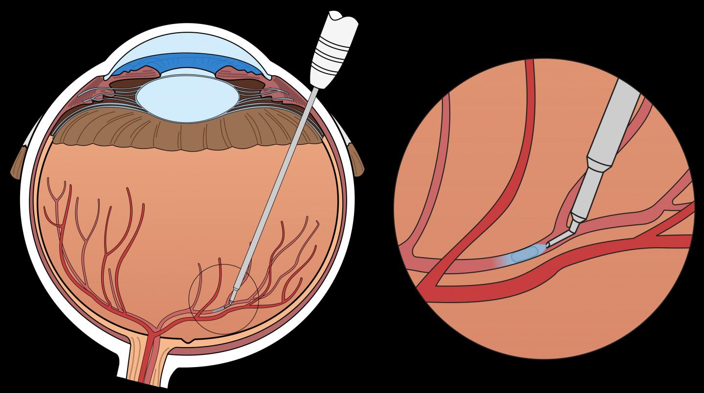 Surgical Eye Robot KU Leuven / University Hospitals Leuven