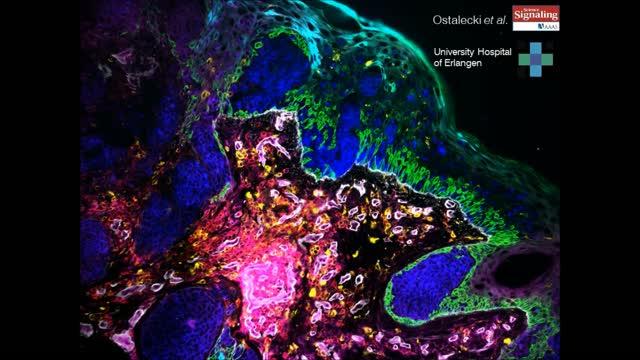 Melanomas Manipulate their Environment (4 of | EurekAlert!