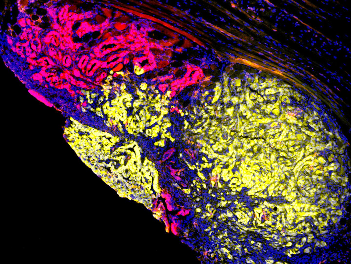 Multi-colored Metastasis