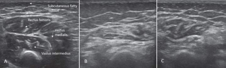 Sonographic findings of quadriceps in child diagnosed with SMA