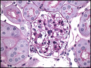 Kidney Structured Damaged in Diabetes