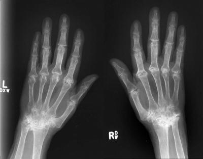 X-Ray Image of Hands of RA Patient
