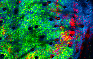 Cancer cells being attacked by neutrophils in the collagen structure of a tumour’s microenvironment. Credit Jacqueline Bailey / Garvan