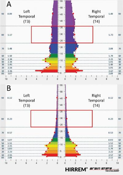 Post-Traumatic Stress Symptoms Reduced after Use of HIRREM Closed-Loop Neurotechnology