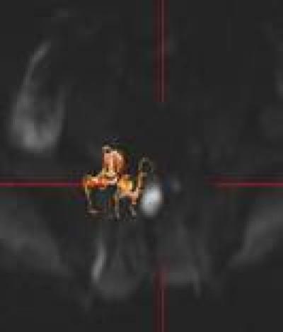 Fiber-Tracking Images of Nerve Roots