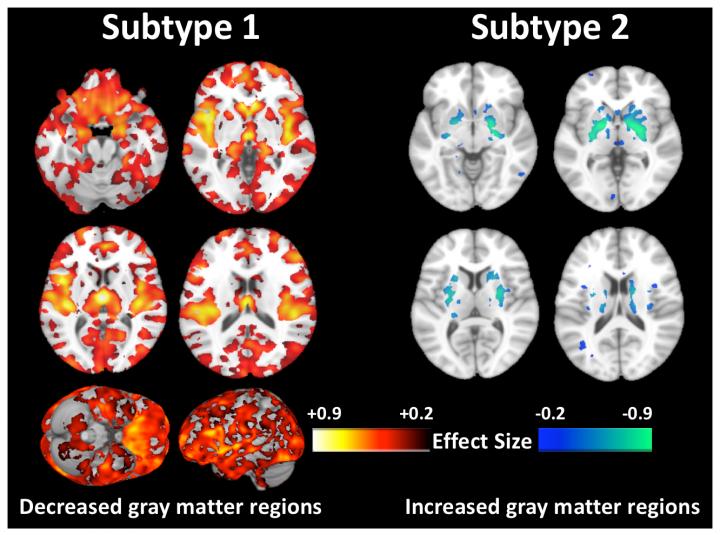 MRI Scans of Schizophrenia Subtypes