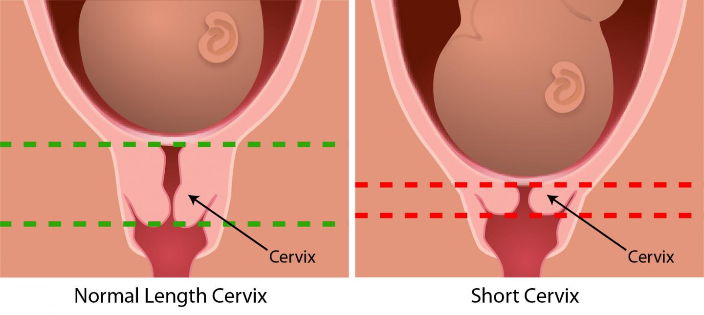 Average Cervix Length At 34 Weeks