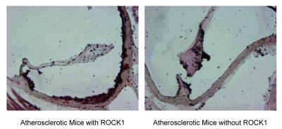 Atherosclerotic Lesion with and without ROCK1
