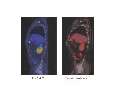 Pre- and Post-CAR-T Cell Therapy