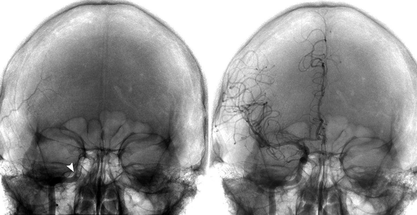 Brain Imaging -- Direct-Aspiration First Pass Technique Was Used to Remove a Large-Vessel Clot