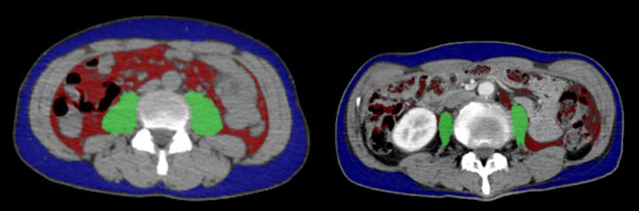 Evaluation of Muscle Mass by Abdominal CT