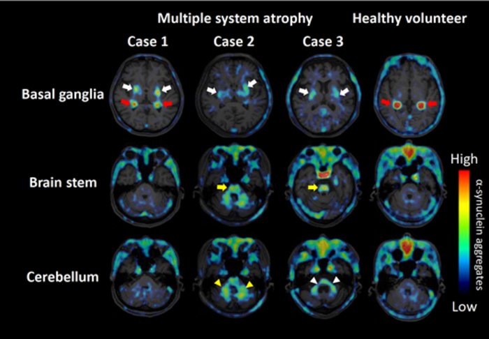 α-synuclein aggregates as seen on a PET scan in patients with MSA and a healthy control
