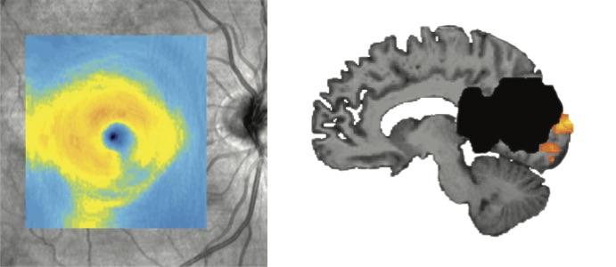 Eye Degeneration And Brain Lesion After Stroke