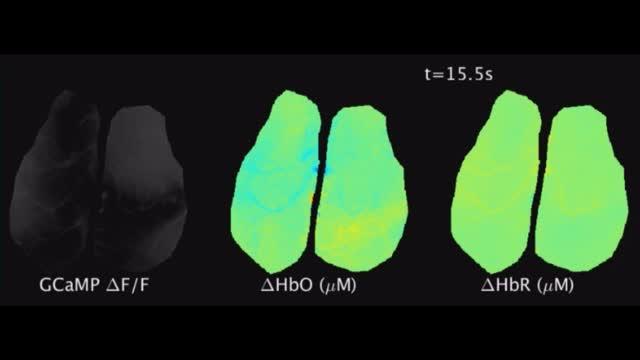 Glioma-induced seizure