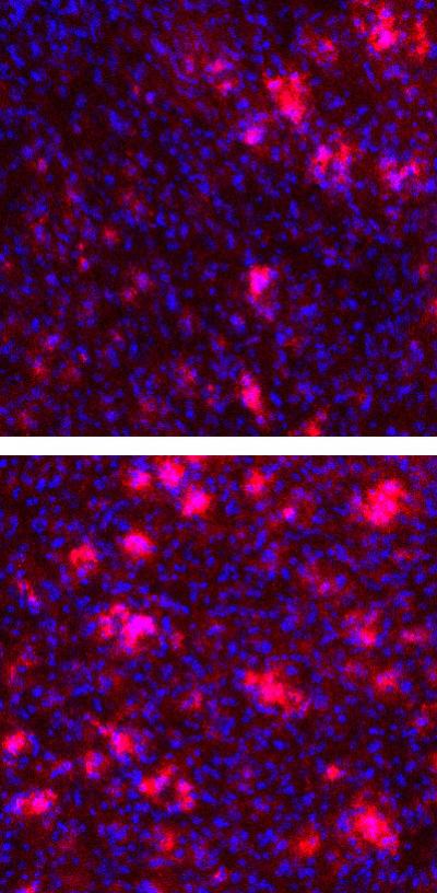 Potential Alzheimer's Drug Prevents Abnormal Blood Clots in the Brain