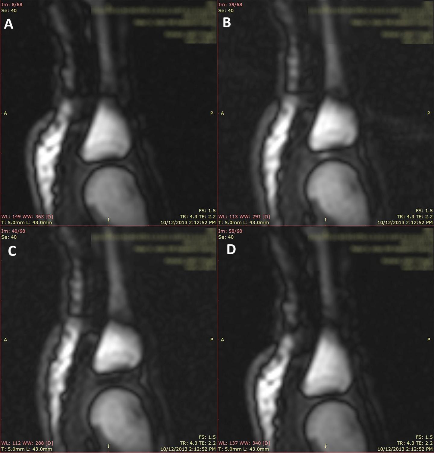 Still Frames from a Representative Trial of Joint Cracking in the Same MCP Joint
