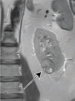 c. 64-Year-Old Man With Clear Cell Likelihood Score (ccLS) 5 Renal Masses
