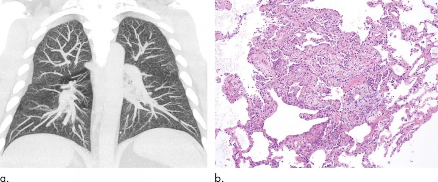 Abnormal Imaging Findings Key to EVALI Diagnosis in Vapers (1 of 3)