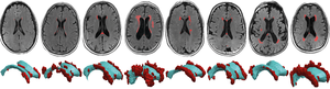 Mechanical pressure of pulsing CSF leads to brain lesions