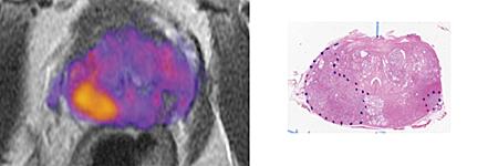 Prostate Cancer Imaging