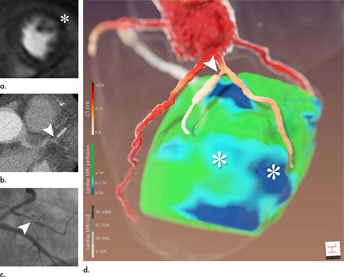 3D Fusion Imaging Improves Cor [IMAGE] | EurekAlert! Science News Releases