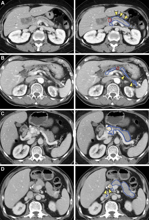 AI Helps Detect Pancreatic Can IMAGE EurekAlert Science News Releases