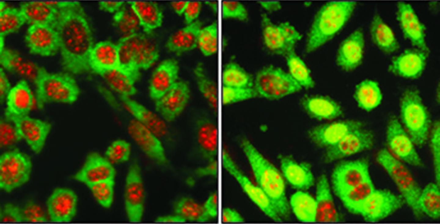 Metastatic Breast Cancer Cells