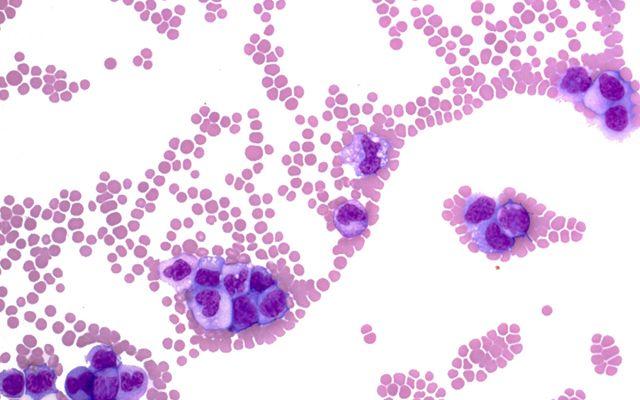 CLL Cells, UC San Diego Health