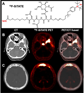 18F-SiTATE PET Formula and Images