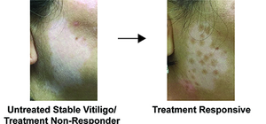 Untreated and Treated Vitiligo