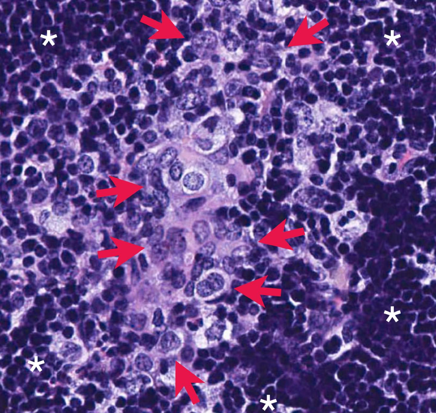 Metastatic Prostate Cancer Cells In Mice