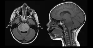 MRI of pediatric brainstem glioma.