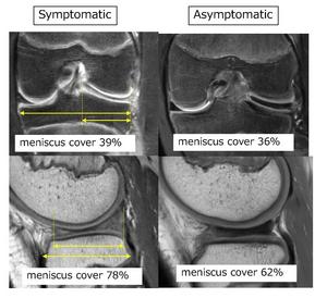 MRI Comparisons of the symptomatic and asymptomatic groups