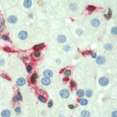 Inflamed Liver Containing Immune Cells Expressing Ap-1 Protein (Brown)