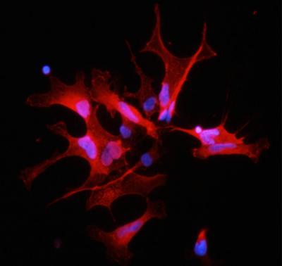 Abnormal Accumulation of the FGFR-TACC Fusion Protein