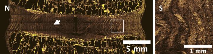 Combined Tissue Engineering Provides New Hope for Spinal Disc Herniations (1 of 2)
