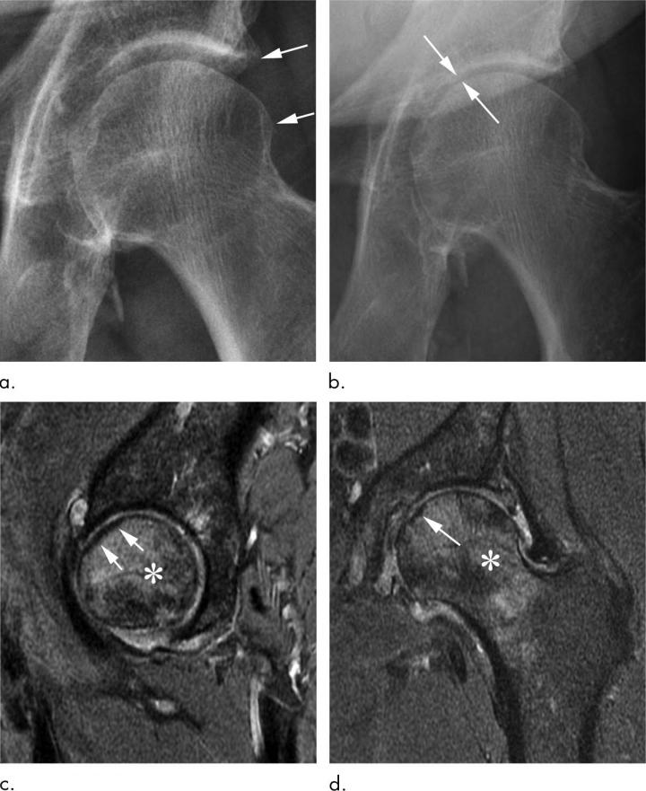 Steroid Injections of Hip and Knee May Damage Joints