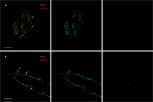 Skin Biopsy Can Help Identify Patients with Parkinson's Disease