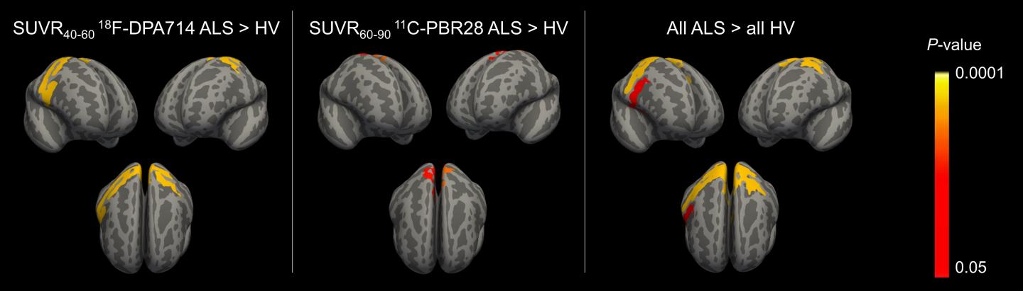 Surface-based analysis between participants with ALS and healthy volunteers.