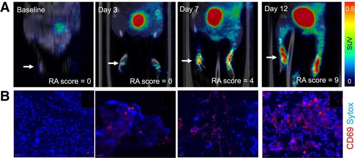 PET images of [68Ga]Ga-DOTA-ZCAM241 uptake in inflammatory arthritis.