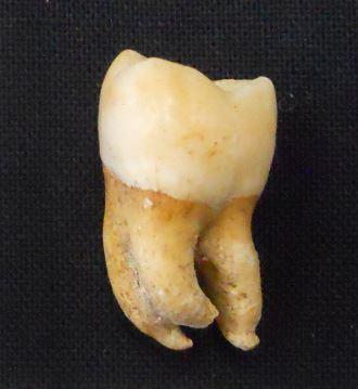 The Whole Tooth: New Method to Find Biological Sex From a Single Tooth