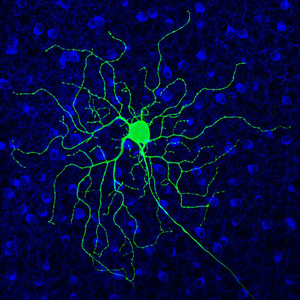 Retinal ganglion cells become hyperactive in progressive blindness