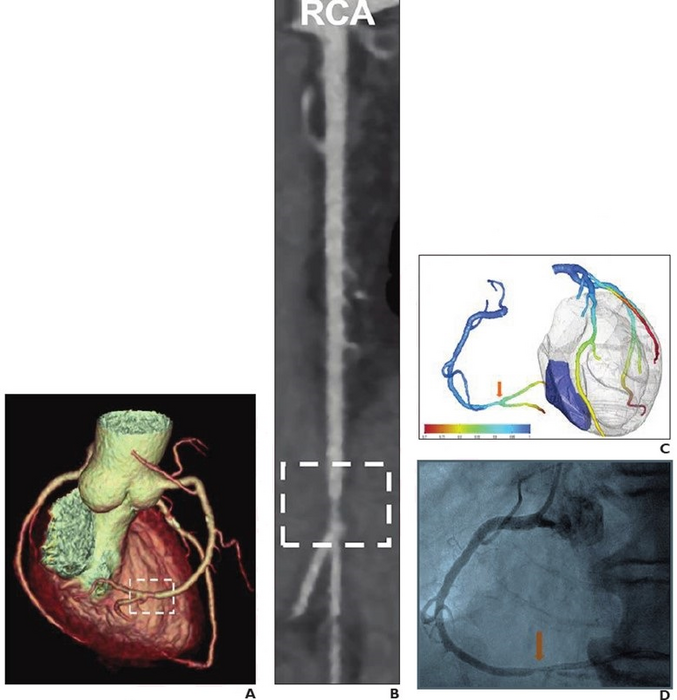 72-year-old with intermediate (50-70%) stenosis in distal right coronary artery, who underwent coronary CTA due to atypical chest pain