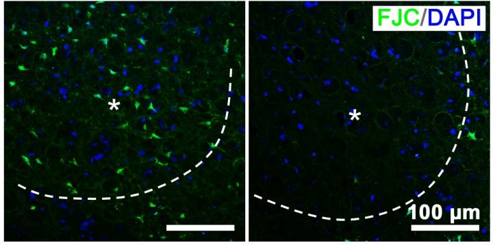 An illuminating possibility for stroke treatment: Nano-photosynthesis