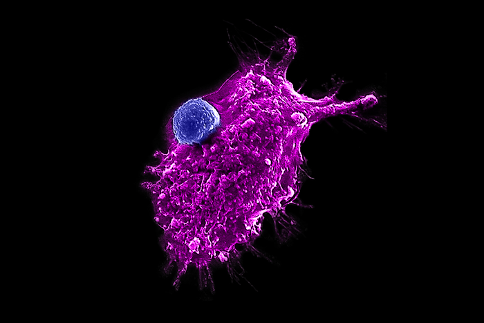 An engineered HSC-iNKT cell (blue) attacking a human tumor cell.