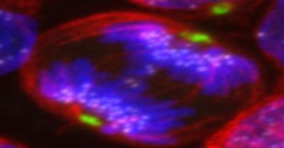 Hyperdiploid B-ALL Blast in Mitosis with Lagging Chromosomes